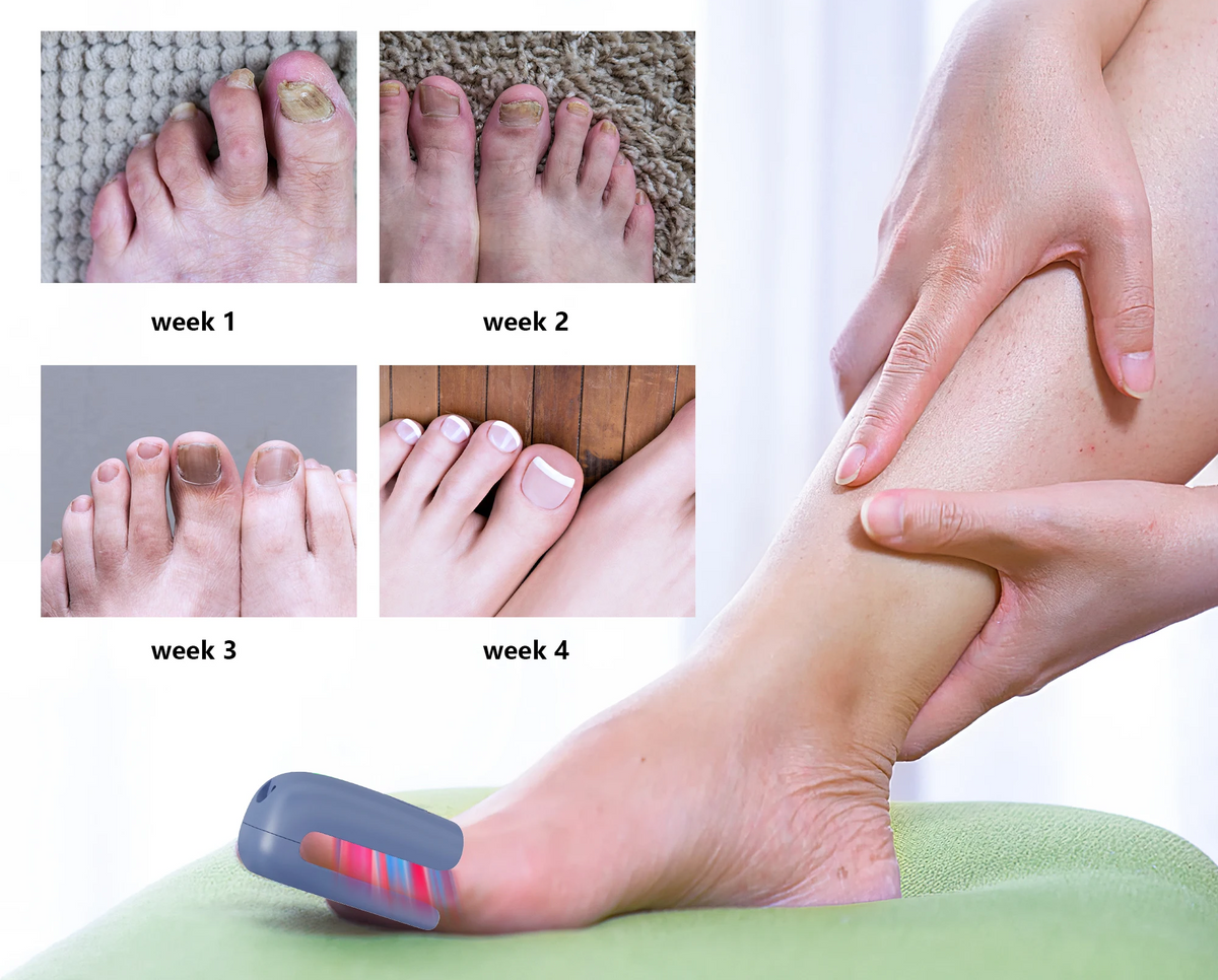 Portable Nail Fungus Removal Device – Treat Nail Discoloration and Thickening Safely at Home with Advanced Anti-Fungal Technology